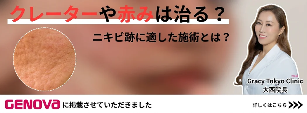 クレーターや赤みは治る？ニキビ跡に適した施術とは？